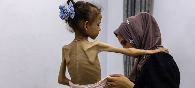 current malnutrition situation in gaza hunger